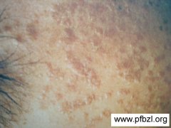 患了扁平疣吃什么食物比较好